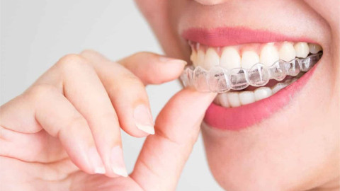 aligners