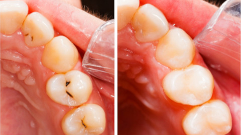 implants