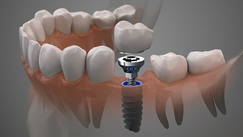 implants