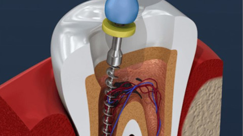 rootcanal