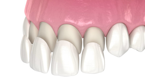 Veneers